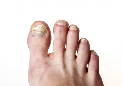 Болезни и проблемы ногтей. С какими проблемами ногтей чаще всего  сталкиваются женщины? Возможное решение, способствующее исцелению
