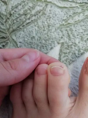 Коричневое пятно на ногте (54 фото)
