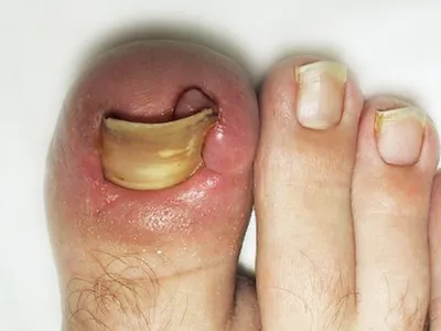 Заболевания ногтей на руках и ногах: фото и описание