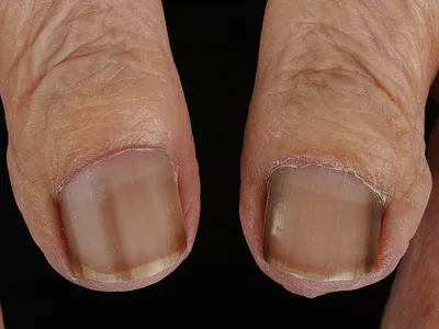 [32+] Негрибковые заболевания ногтей на ногах фото