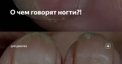 Белые пятна на ногтях причины (56 фото)