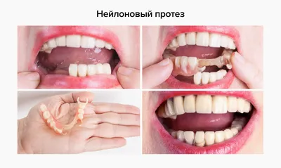 НЕЙЛОНОВЫЙ ПРОТЕЗ. Фото До и После. Видео. Цены. Для всех