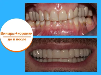 Съемное протезирование зубов | стоматологическая клиника Нардент