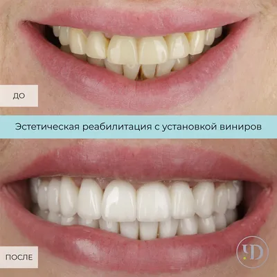 Изготовление нейлоновых зубных протезов в Москве под ключ