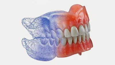 Съемный зубной протез на верхнюю челюсть — цена в Москве, особенности ❘  Ортодонт Комплекс