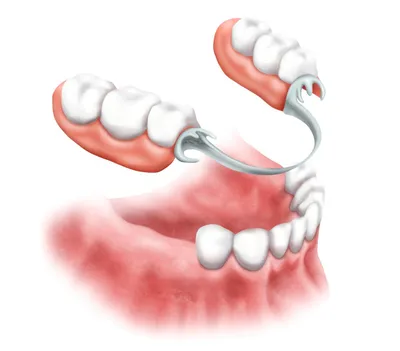 Верхний зубной протез: цена, виды протезов на верхнюю челюсть | НоваДент