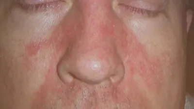 Атопический дерматит на лице и теле у взрослых - лечение в СПб