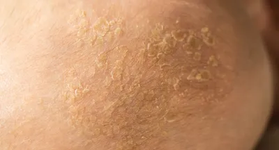 Периоральный дерматит, как спасти кожу? Проверено на себе 👍 - YouTube