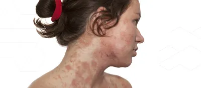 Атопический дерматит на лице фото