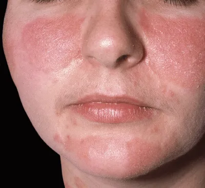 Себорейный дерматит на лице беспокоил моего пациента около 10 лет! ⠀  Листайте галерею 👉🏻 и посмотрите, как может проявлять себя данный… |  Instagram