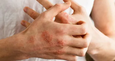Какие последствия атопического дерматита? | Пробиотики Нормофлорины –  лечение дисбактериоза