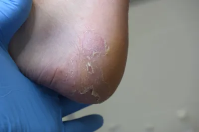 дишидротная экзема на ноге. волшебный дерматит. обрабатывается мазью.  закрытие Стоковое Фото - изображение насчитывающей аллергически, макрос:  220692254