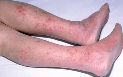 Ноги пациента с псориазом хронический аутоиммунный дерматит, концепция  воспаления кожи аутоиммунном здравоохранения. Стоковое Фото - изображение  насчитывающей концепция, ноги: 197932364