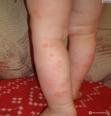 Атопический дерматит - как избежать обострения дерматита у детей летом  рассказала врач Екатерина Бакико - «ФАКТЫ»