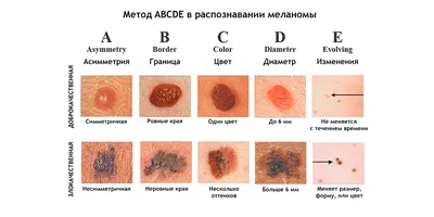 Что такое меланома? / Здравствуйте - YouTube