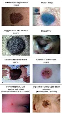 Доброкачественные и злокачественные невусы: тревожные признаки больших  родинок | ОГАУЗ Детская городская больница №2