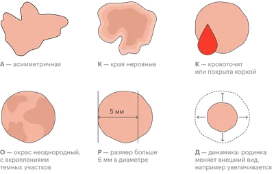 Как определить злокачественную родинку: виды и признаки | Клиника Родинка |  Дзен