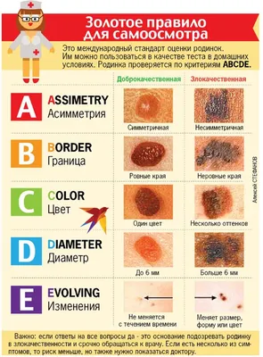 Опасные родинки: признаки злокачественных родинок, фото — MLC