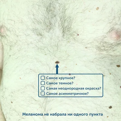 Как отличить рак кожи от меланомы — фото с примерами и рекомендации  онколога - 2 декабря 2019 - 29.ру