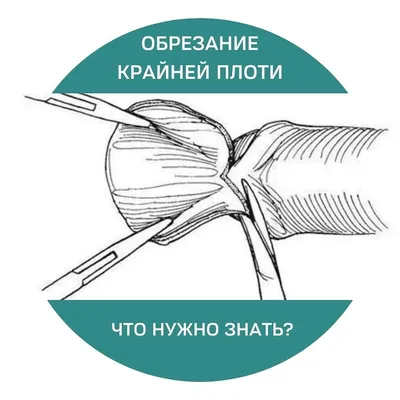 Уролог Колосов - ЛЕЧЕНИЕ ФИМОЗА. ОБРЕЗАНИЕ❗️❗️❗️ Крайняя плоть – это кожное  образование, совершенно необходимое мужчине. Ее основные функции: •  Механическая защита. Вероятность микротравм и, как следствие, присоединение  вторичного инфицирования ...