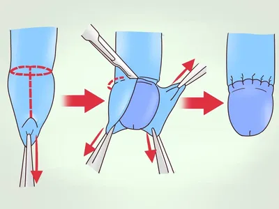 Обрезание — это, пожалуй, одна из самых деликатных и неоднозначных тем  мужской урологии | Uniserv Medical Center