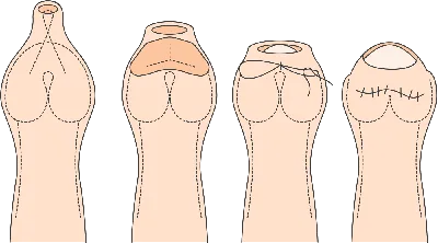 Урология: Варикоцеле | iVF Riga