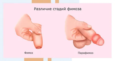 Обрезание у мужчин: зачем делают, схема, плюсы и минусы, сколько стоит  циркумцизия