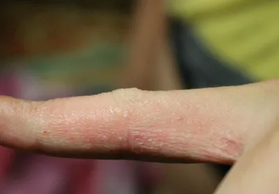 Экзема на пальцах рук: причины, виды, симптомы и лечение болезни