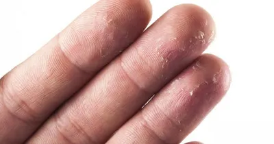 Экзема на пальцах рук: причины, виды, симптомы и лечение болезни