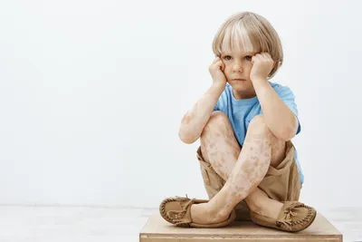 Витилиго у детей: причины, симптомы, диагностика и лечение — Статьи — ОН  КЛИНИК Бейби