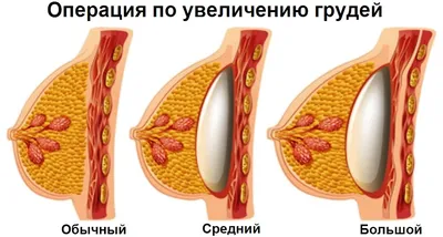 Асимметрия груди - коррекция операцией, от 110 000 рублей.