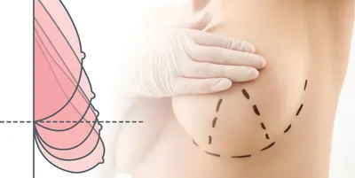 Якорная подтяжка груди | Пластическая хирургия в деталях | Дзен