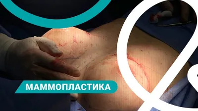 Клиника косметологии GMTClinic on Instagram: \"Результат увеличения молочных  желез имплантами Mentor✨ ⠀ ✨ К.м.н., врач-пластический хирург - Гроссман  Станислав Сергеевич @doctor.grossman ✨ Маммопластика - пластическая  операция, которая позволяет ...