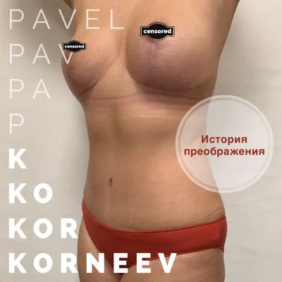 Подтяжка груди в Минске - ❤️ Цена на мастопексию