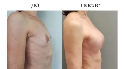 Подтяжка груди (мастопексия) в Киеве цена, отзывы ᐈ Certus | Certus