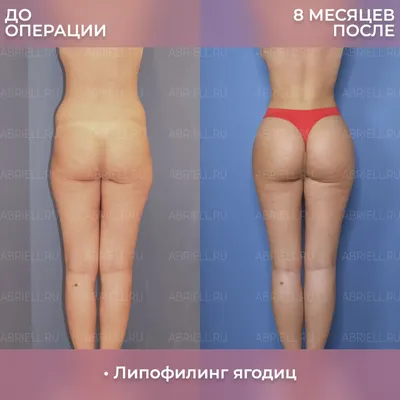Уменьшение груди, якорная подтяжка без имплантов - маммопластика, цена в  Москве