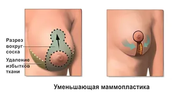 ▷ Уменьшение груди Киев ➡️ редукционная маммопластика