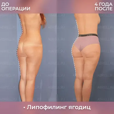 Фото до и после липофилинга ягодиц