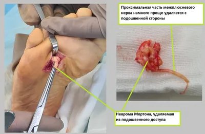 Неврома Мортона | Фото до и после, операция, отзывы, лечение, реабилитация  и восстановление