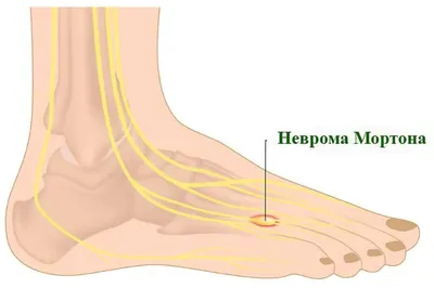 Неврома Мортона на МРТ: особенности проведения МРТ при невроме Мортона