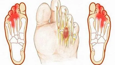 Неврома Мортона: симптомы, причины, лечение в Херсоне | Neuro.ks.ua.