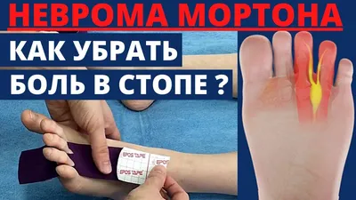 Удаление невромы (метатарзалгии) Мортона | 🏥 Клиника НАКФФ