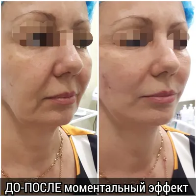 Мезонити для лица в Москве по цене от 950 руб. в клинике Beauty Trend