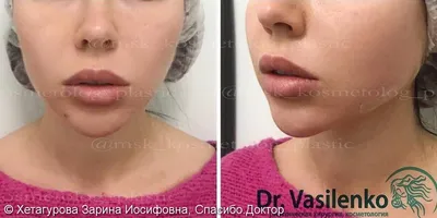 Нитевой лифтинг SoftLift фото до и после, отзывы, цена