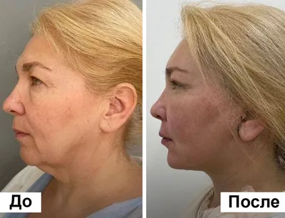 Нитевой лифтинг в клинике хирурга Амжада Аль-Юсефа (Москва)