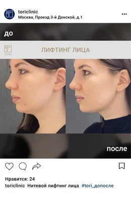 Нитевой лифтинг - подтяжка лица 3D мезонитями в клинике Медицина для Вас на  Красносельской