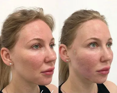 Как выглядит подтяжка нитями в фото До и После - Cosmetic-clinic
