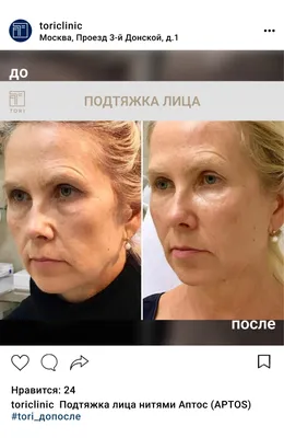 Нитевой лифтинг в Москве: цены, фото до и после, отзывы | Стоимость  нитевого лифтинга в клинике Seline