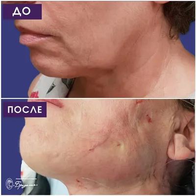 Нитевой лифтинг лица в Москве — VIP Clinic. Подтяжка лица без операции  нитями лифтинг нижней трети лица, носогубных складок, под глазами, нитевой  лифтинг подбородка и овала лица, шеи, брылей. Стоимость подтяжки, цены