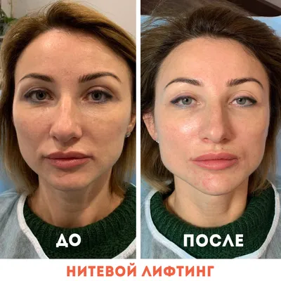Нитевой лифтинг лица - цена в Москве | клиника Медиал